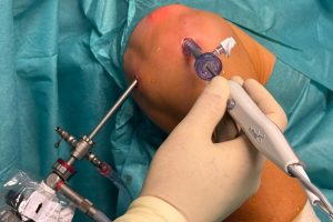 Bild eines Arthrodkopischen Eingriffs